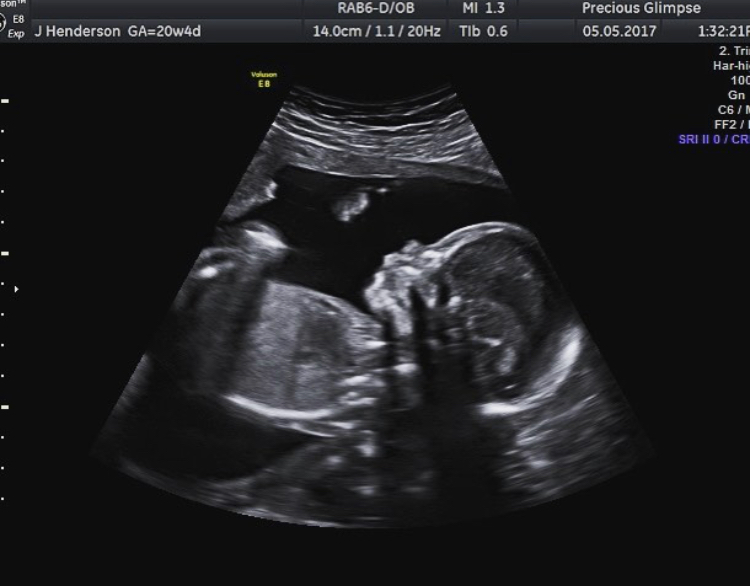 A 2D black-and-white ultrasound scan image