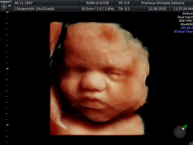 A 4D HD Live ultrasound image of a baby's face at Precious Glimpse